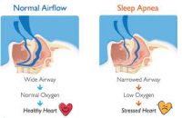 Sleep Apnea and VA Service-Connected Compensation