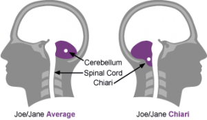 Picture of normal brain and brain with chiari malformation